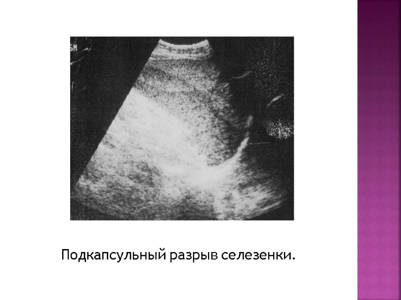 Подкапсульный разрыв селезенки.